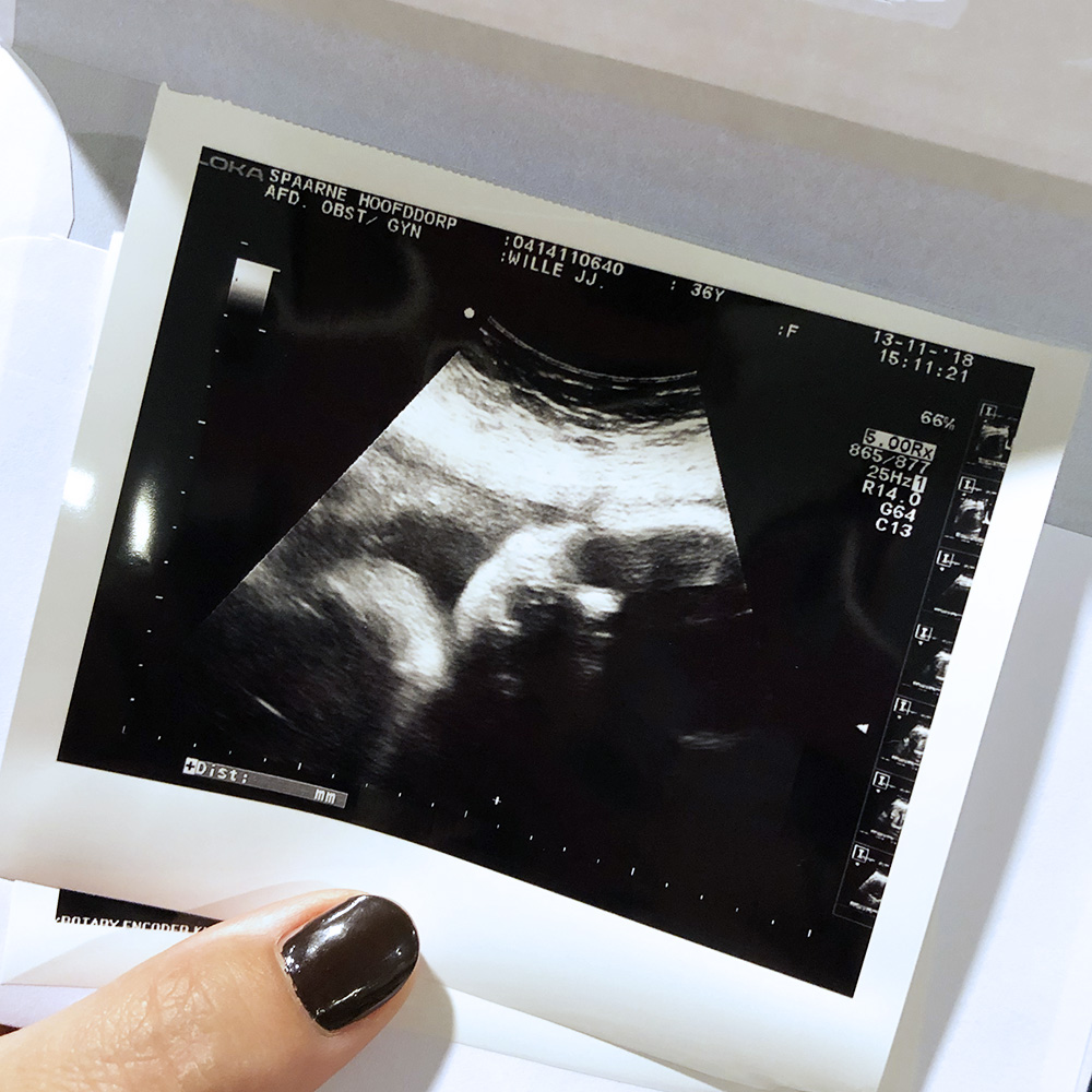 35 weken zwanger: hoe gaat het tot nu toe?